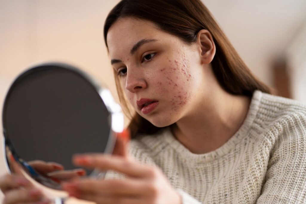 Woman examining acne-prone skin in mirror, highlighting potential side effects and precautions of Vitamin C serum