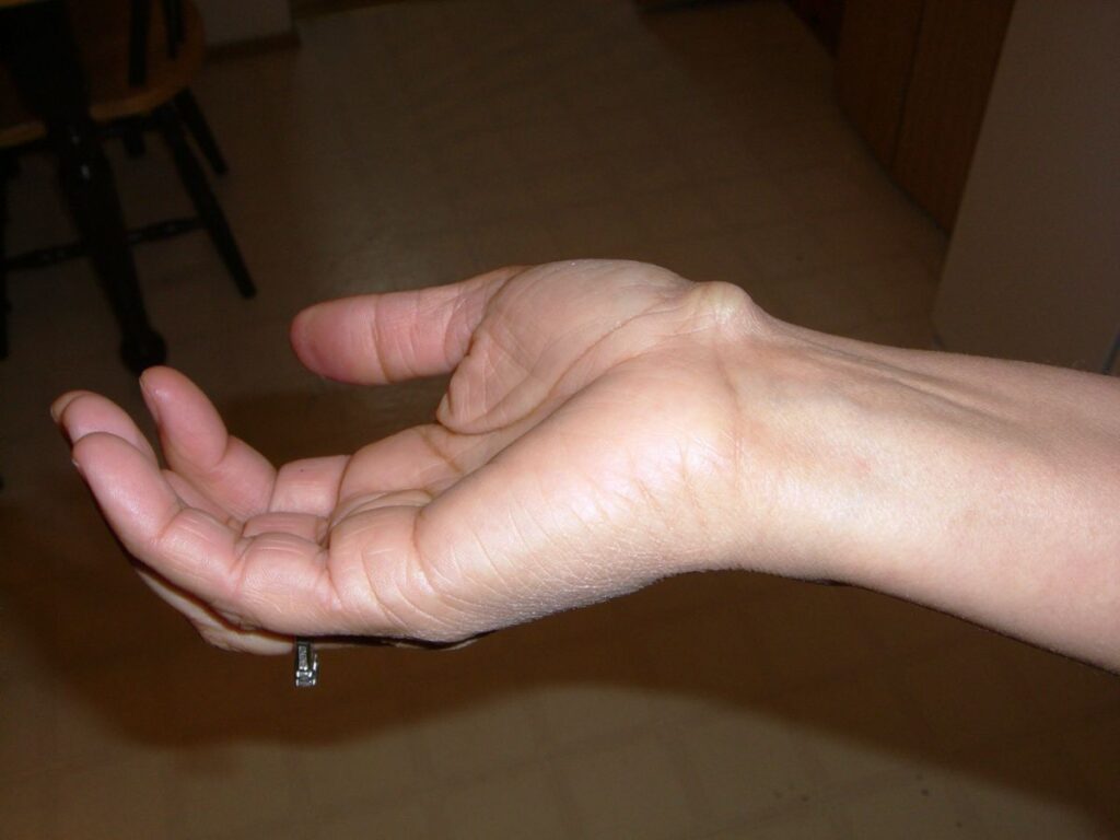 Hand with a visible ganglion cyst vitamin deficiency on the wrist