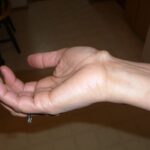 Hand with a visible ganglion cyst vitamin deficiency on the wrist