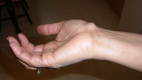 Hand With A Visible Ganglion Cyst Vitamin Deficiency On The Wrist