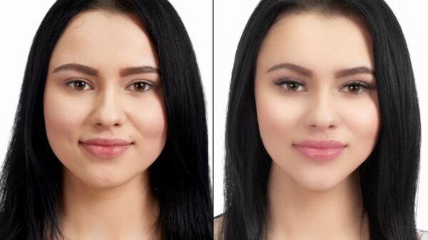 Side-By-Side Comparison Of A Woman'S Face Before And After Buccal Fat Removal Surgery, Showing Noticeable Changes In Facial Contours.