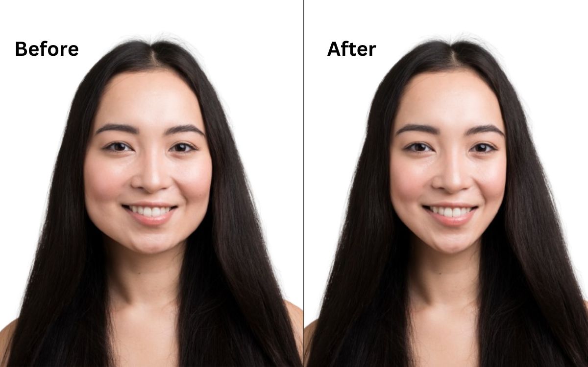 Buccal Fat Removal Before and After: A woman's face shown in a side-by-side comparison to highlight the changes post-surgery.