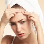 does accutane get rid of acne scars A young woman with a white towel wrapped around her head is pressing her fingers against pimples on her forehead. She appears to be frustrated or concerned about her acne.