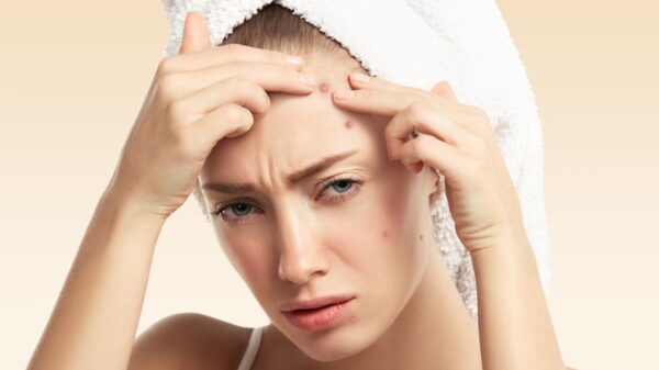 does accutane get rid of acne scars A young woman with a white towel wrapped around her head is pressing her fingers against pimples on her forehead. She appears to be frustrated or concerned about her acne.