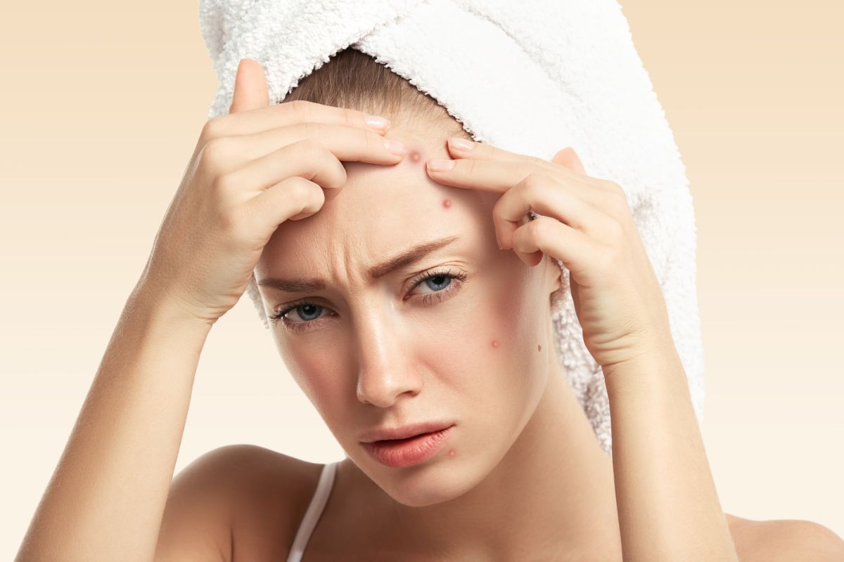 does accutane get rid of acne scars A young woman with a white towel wrapped around her head is pressing her fingers against pimples on her forehead. She appears to be frustrated or concerned about her acne.