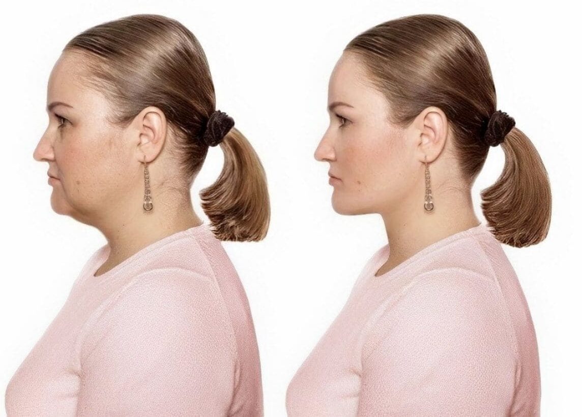 Neck Fat Lose Before And After, Showing A Woman How To Lose Neck Fat