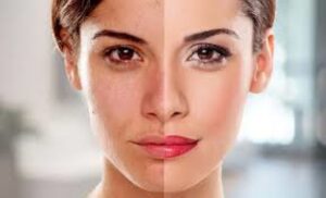 Skin Whitening Injection Before and After