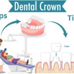 Loose Crown Treatment