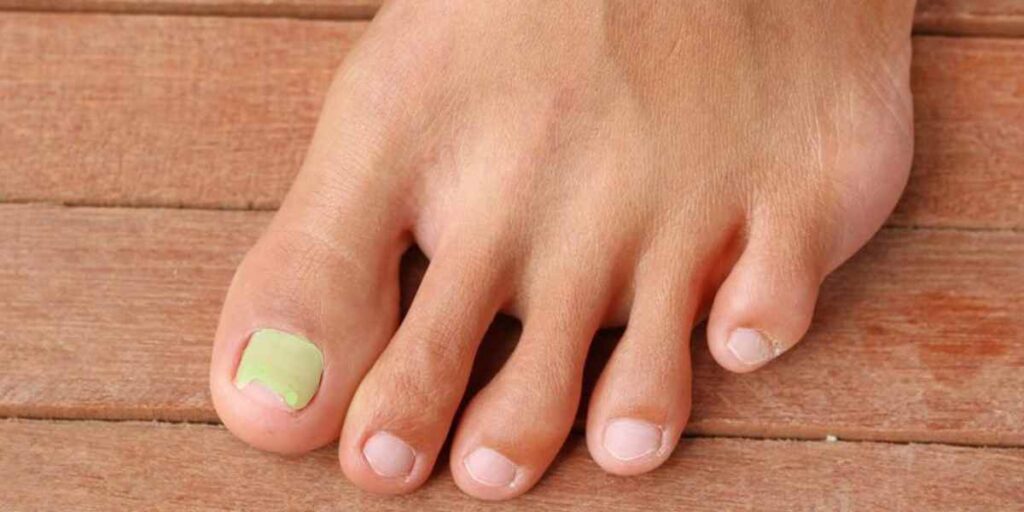 Pros and Cons of Laser Treatment for Toenail Fungus