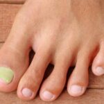 Pros and Cons of Laser Treatment for Toenail Fungus