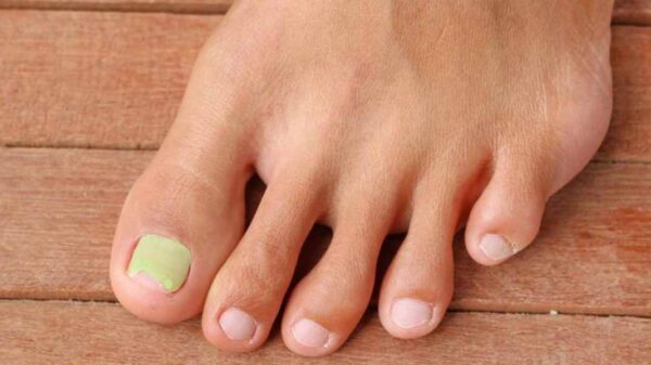 Pros and Cons of Laser Treatment for Toenail Fungus