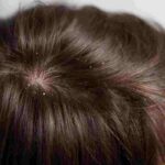 Dry Scalp Causes And Remedies.