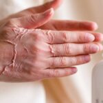 Dry Skin Symptoms &Amp; Causes Diagnose The Need For Lotion