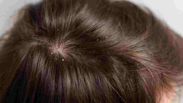 Dry scalp causes and remedies.