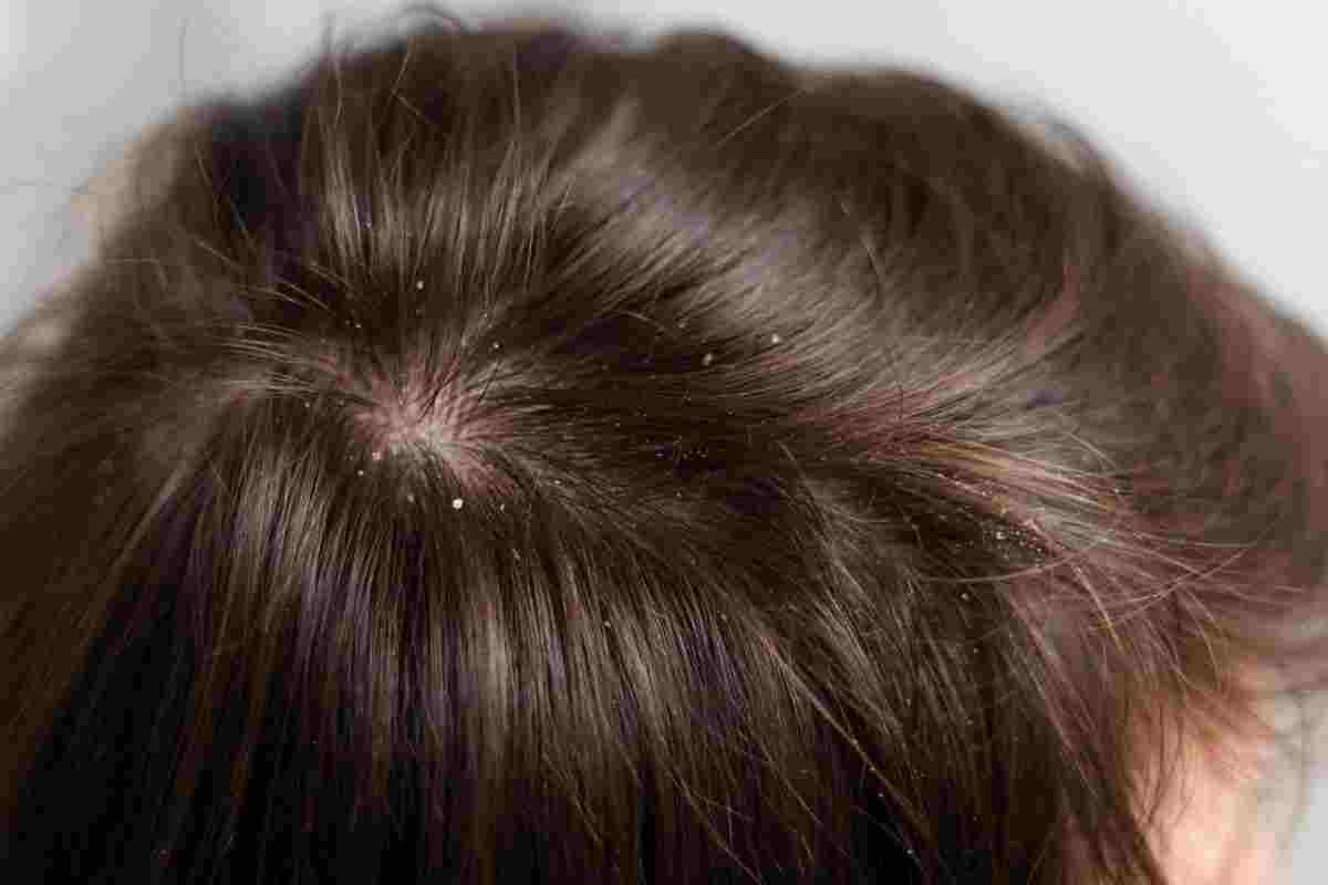Dry scalp causes and remedies.