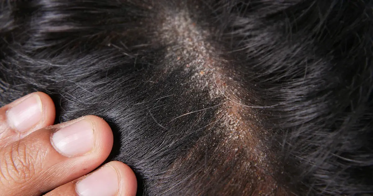 A Close-Up Photo Of A Person Scratching A Dry Scalp With Visible Flaking, Crusty Buildup, And White Flakes Along The Hair Parting On Dark Hair, Showing The Real Symptoms Of A Dry Scalp Condition.