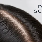 Overhead Close-Up View Of A Dry Scalp With Small White Flakes Scattered Along The Hair Parting And Across Dark Brown Hair, With The Text &Quot;Dry Scalp&Quot; Displayed On A Light Grey Background.
