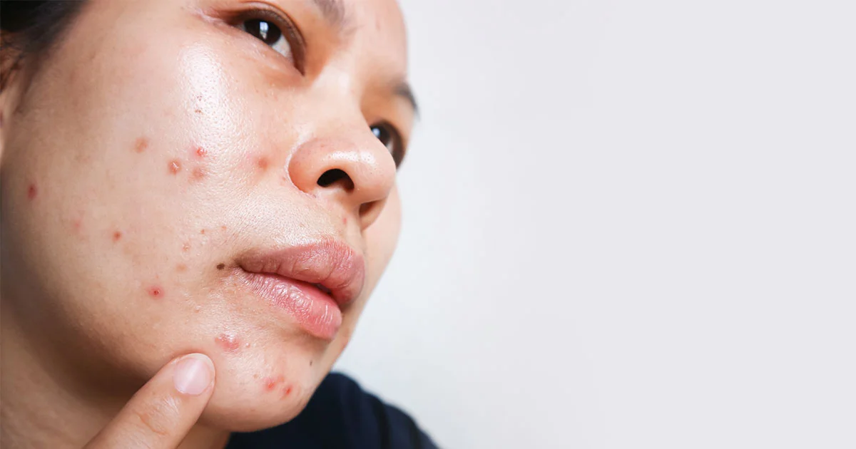 A Close-Up Side Profile Of A Young Asian Woman With Visible Acne Around The Mouth, Chin, And Cheeks — Including Inflamed Pimples And Pustules — Gently Touching Her Jaw With One Finger Against A Clean White Background, Representing A Relatable Experience Of Perioral Acne Around The Mouth And The Need For Targeted Skincare Treatment.
