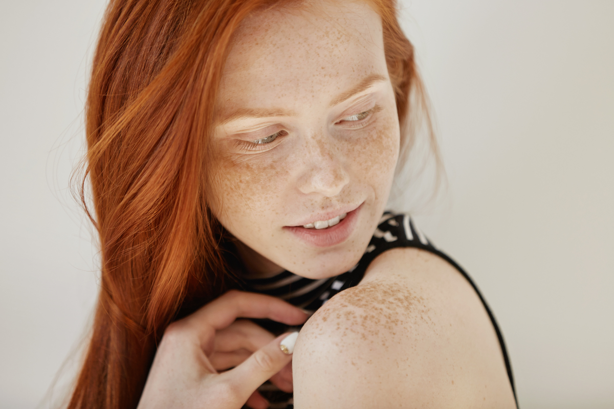 Skin Texture Can Make Freckles Look Worse Than They Are